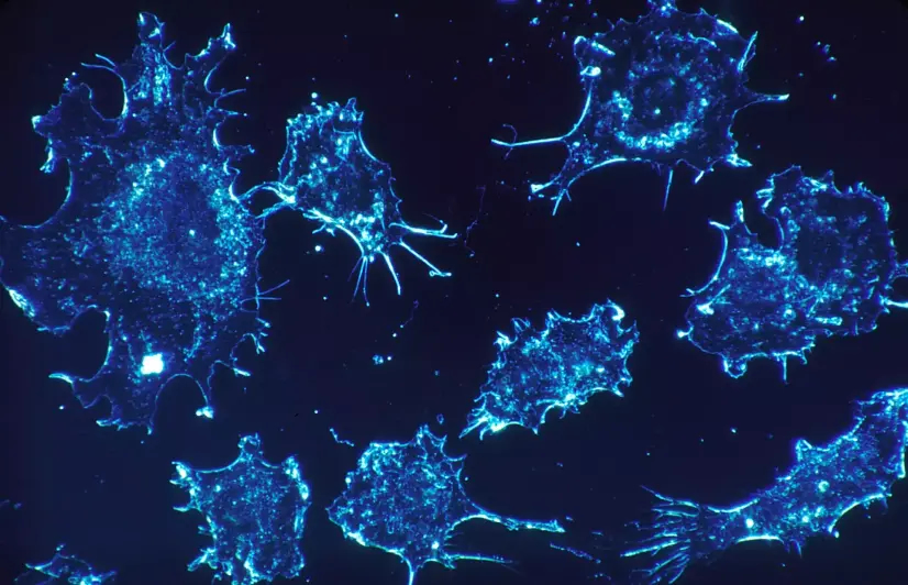 Cancer care in Kashmir under severe strain