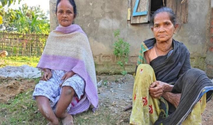Deformed and distressed, fluorosis patients of Assam still await regular potable water supply